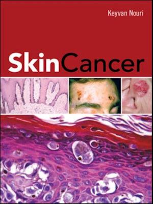 Skin Cancer