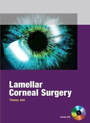 Lamellar Corneal Surgery