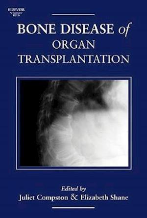 Bone Disease of Organ Transplantation