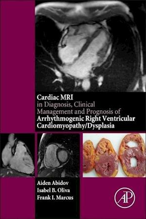 Cardiac MRI in Diagnosis, Clinical Management, and Prognosis of Arrhythmogenic Right Ventricular Cardiomyopathy/Dysplasia