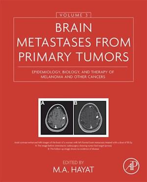 Brain Metastases from Primary Tumors, Volume 3