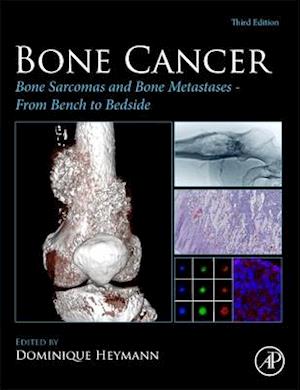 Bone Cancer