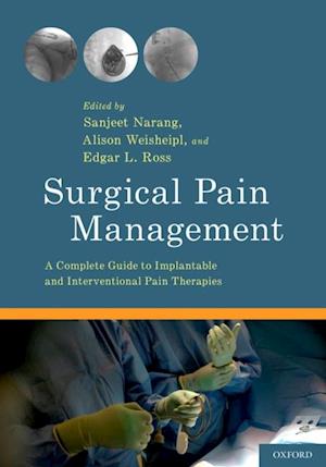 Surgical Pain Management