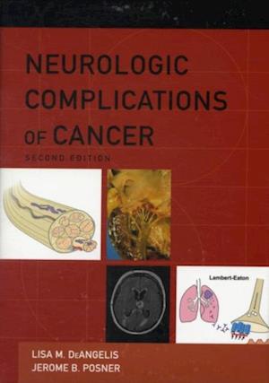 Neurologic Complications of Cancer