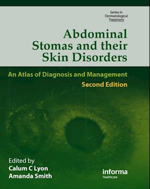 Abdominal Stomas and Their Skin Disorders