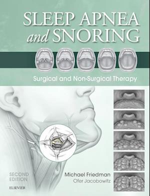 Sleep Apnea and Snoring