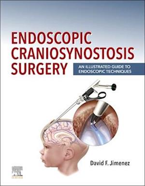 Endoscopic Craniosynostosis Surgery