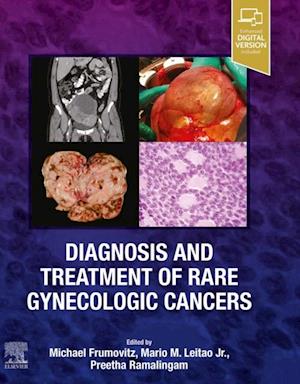 Diagnosis and Treatment of Rare Gynecologic Cancers - E-Book