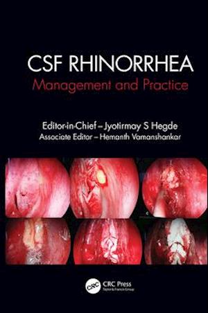 CSF Rhinorrhoea