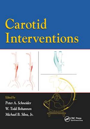 Carotid Interventions