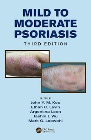 Mild to Moderate Psoriasis