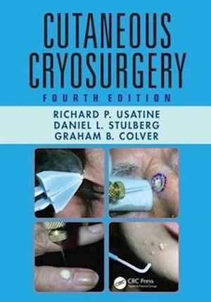 Cutaneous Cryosurgery