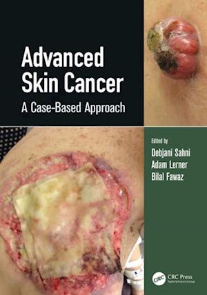 Advanced Skin Cancer