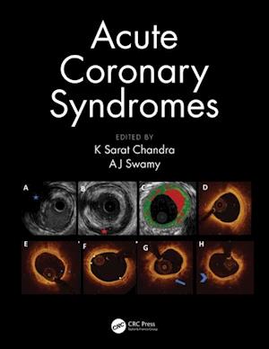 Acute Coronary Syndromes