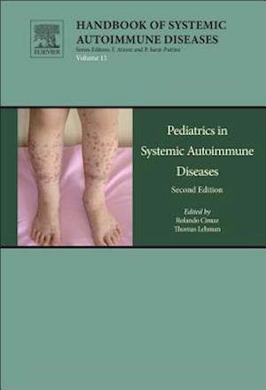 Pediatrics in Systemic Autoimmune Diseases