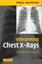 Interpreting Chest X-Rays