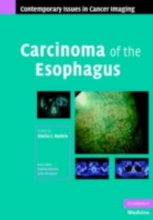 Carcinoma of the Esophagus