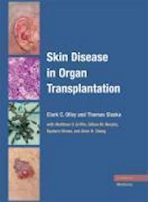 Skin Disease in Organ Transplantation