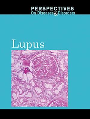 Lupus