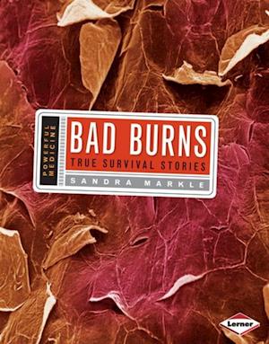 Bad Burns