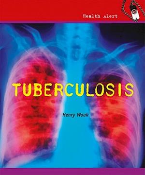 Tuberculosis