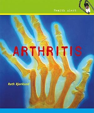 Arthritis