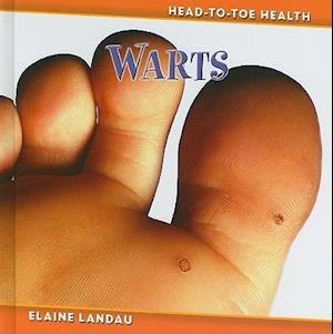 Warts