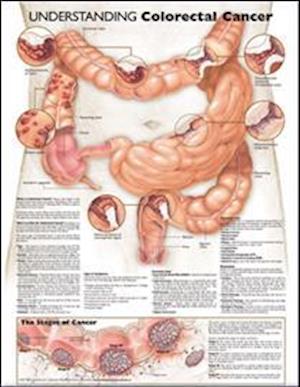 Understanding Colorectal Cancer Anatomical Chart