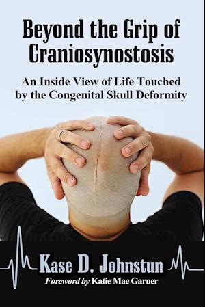 Beyond the Grip of Craniosynostosis