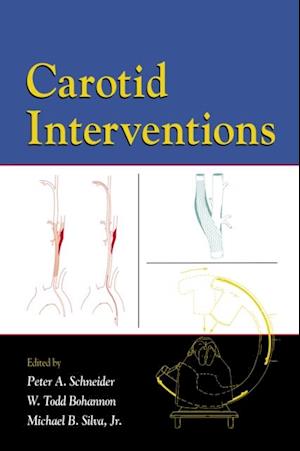 Carotid Interventions