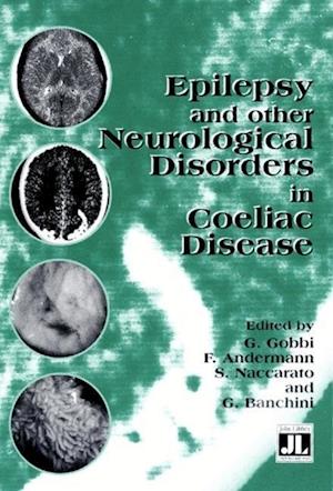 Epilepsy & Other Neurological Disorders in Coeliac Disease