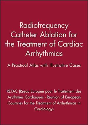 Radiofrequency Catheter Ablation for the Treatment of Cardiac Arrhythmias