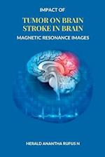 Impact of Tumor on Brain Stroke in Brain Magnetic Resonance Images 