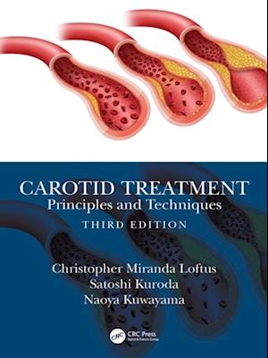 Carotid Treatment: Principles and Techniques