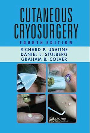 Cutaneous Cryosurgery