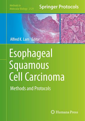 Esophageal Squamous Cell Carcinoma