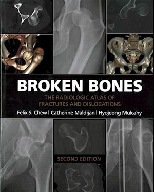 Broken Bones