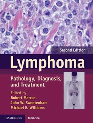 Lymphoma