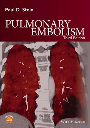 Pulmonary Embolism