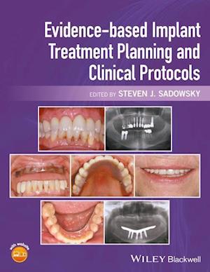 Evidence–based Implant Treatment Planning and Clinical Protocols