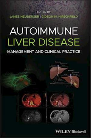 Autoimmune Liver Disease