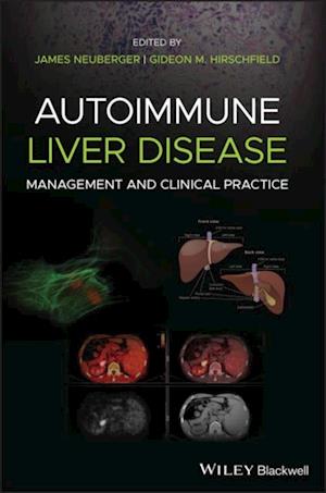 Autoimmune Liver Disease