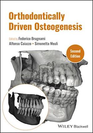 Orthodontically Driven Regenerative Corticotomy, S econd Edition