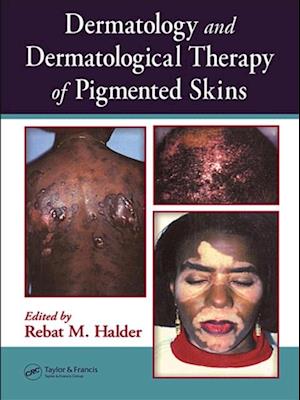 Dermatology and Dermatological Therapy of Pigmented Skins