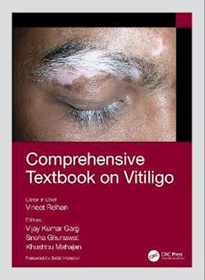 Comprehensive Textbook on Vitiligo