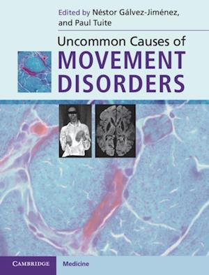 Uncommon Causes of Movement Disorders