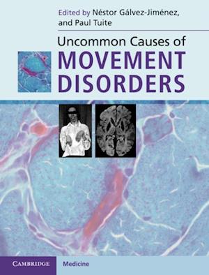 Uncommon Causes of Movement Disorders