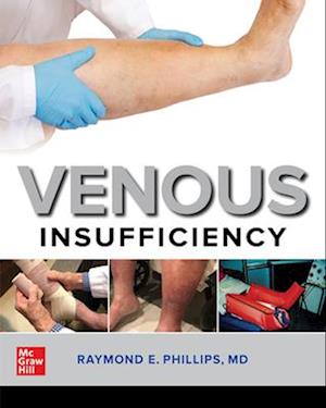 Venous Insufficiency