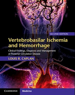 Vertebrobasilar Ischemia and Hemorrhage