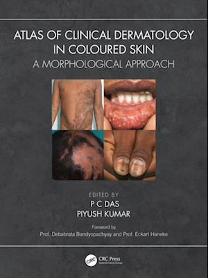 Atlas of Clinical Dermatology in Coloured Skin